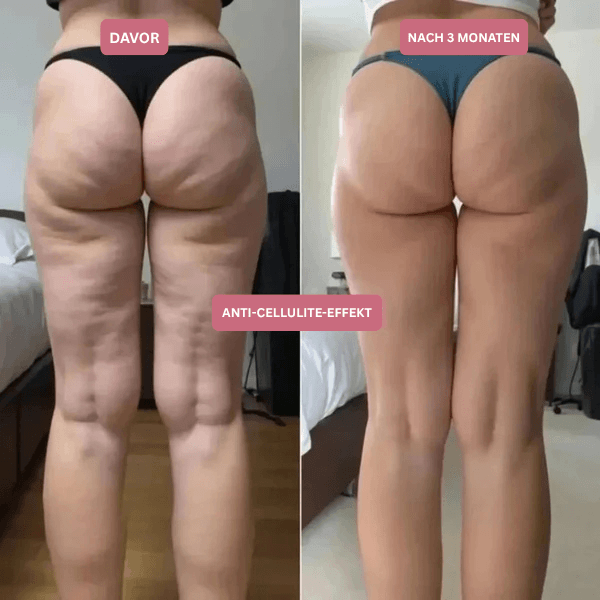 3D Anti-Cellulite Kompressionsleggings