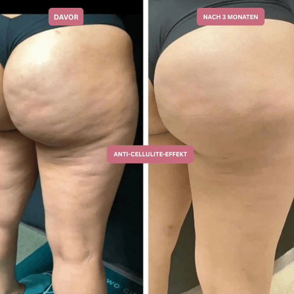 3D Anti-Cellulite Kompressionsleggings
