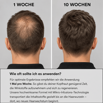 Volora Infuse™ | Mikro-Infusionssystem für die Kopfhaut