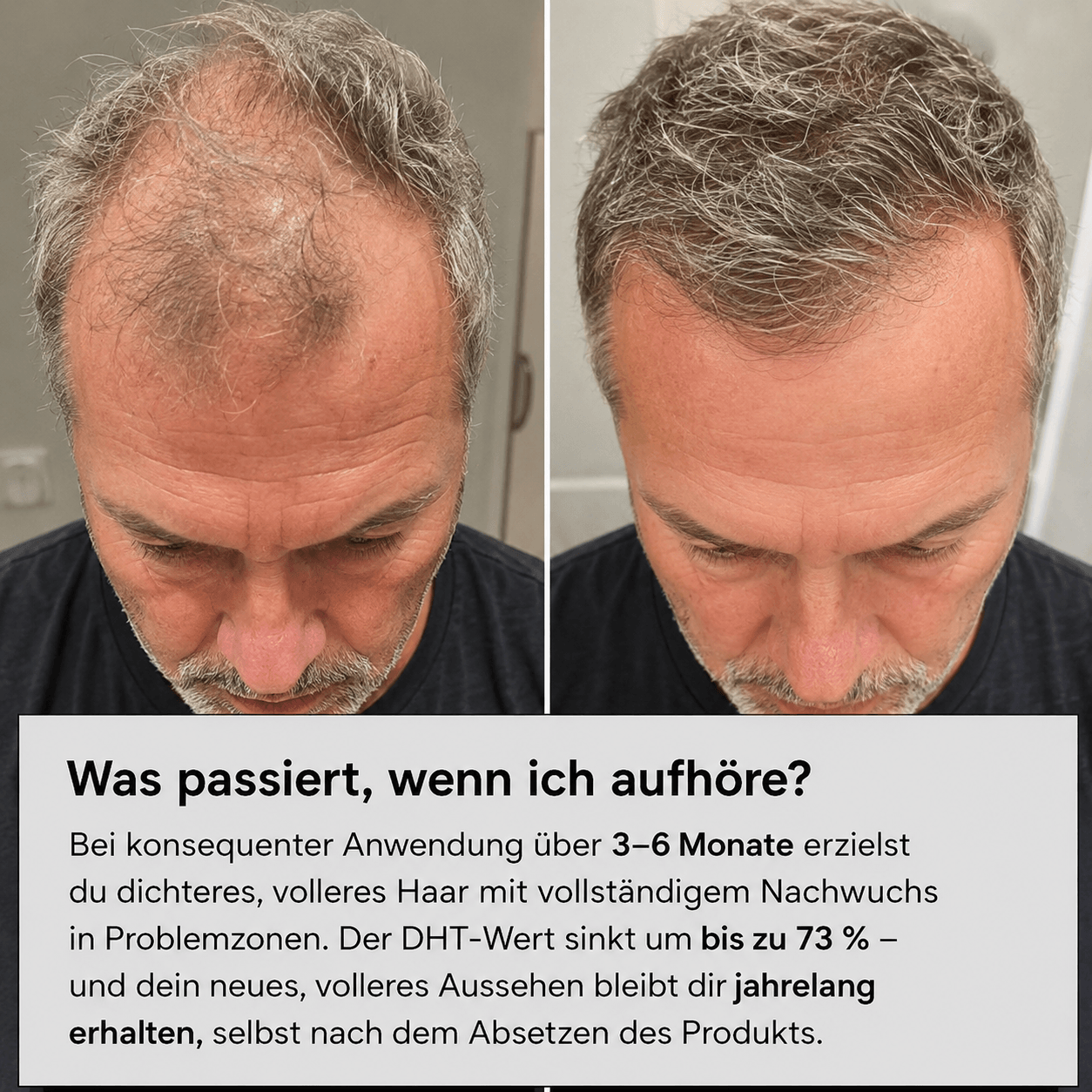 Volora Infuse™ | Mikro-Infusionssystem für die Kopfhaut