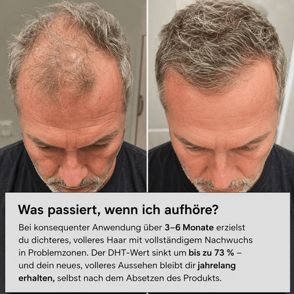 Volora Infuse™ | Mikro-Infusionssystem für die Kopfhaut