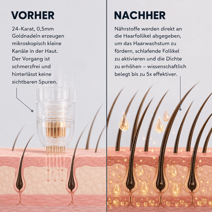 Volora Infuse™ | Mikro-Infusionssystem für die Kopfhaut